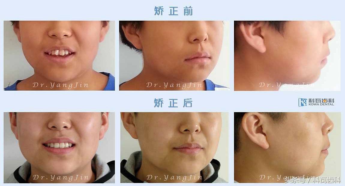 青少年适合种植牙还是假牙,缺牙活动假牙修复