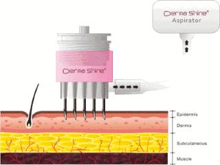 医美的水光针是怎么做的,医美专用水光针品牌