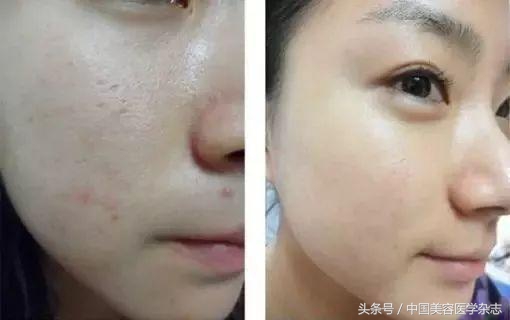 医美的水光针是怎么做的,医美专用水光针品牌