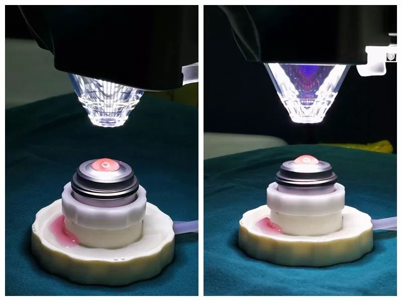 在小小眼球上,三台手术同时进行,不服不行!