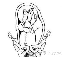 五一特辑异常妊娠：胎位不正原来是这样一回事！