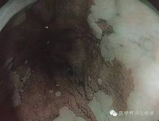 barrett食管的症状是什么,barrett食管症状可怕吗