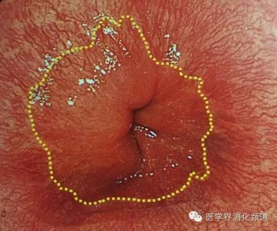 barrett食管的症状是什么,barrett食管症状可怕吗