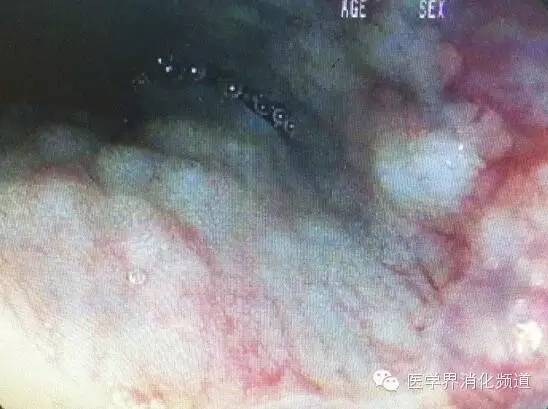 barrett食管的症状是什么,barrett食管症状可怕吗