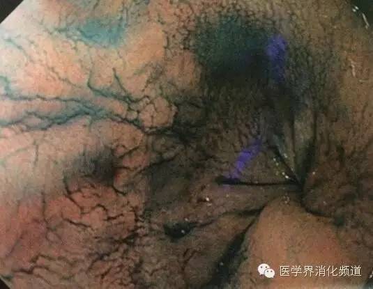 barrett食管的症状是什么,barrett食管症状可怕吗