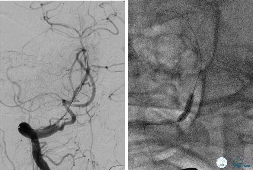 颅内动脉狭窄介入治疗研究,颅内血管cta副作用