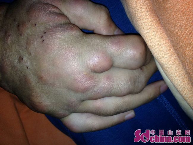 15岁男孩身患组织细胞肉瘤,小孩轻微恶性肉瘤能治好吗