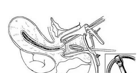 上了避孕环之后为什么还是会怀孕,为什么带上避孕环还会怀孕呢