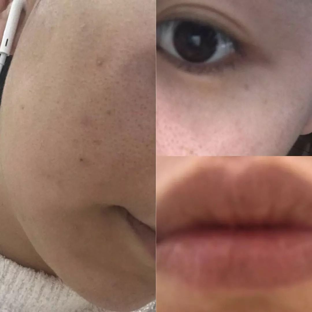 为什么明星不爆痘,熬夜真的会导致爆痘吗