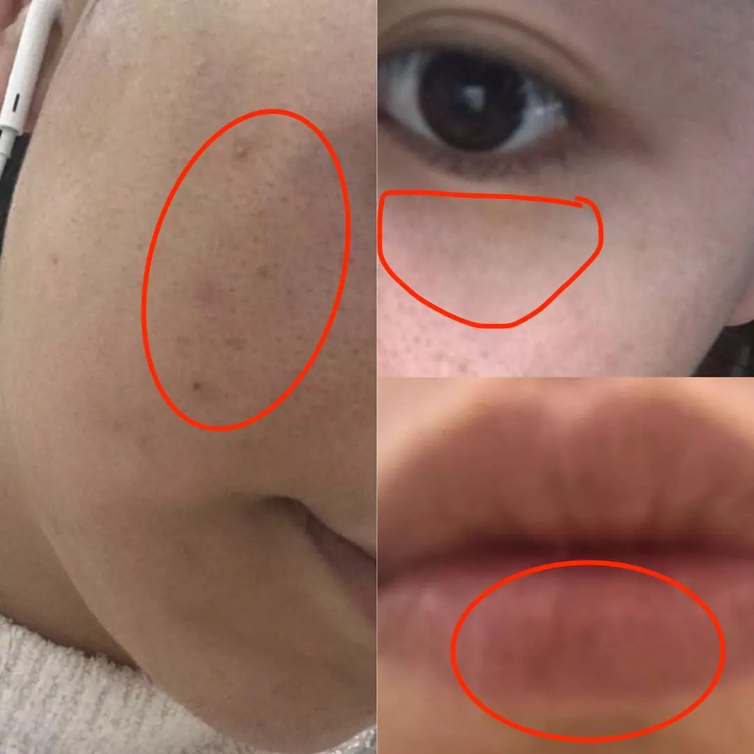 为什么明星不爆痘,熬夜真的会导致爆痘吗