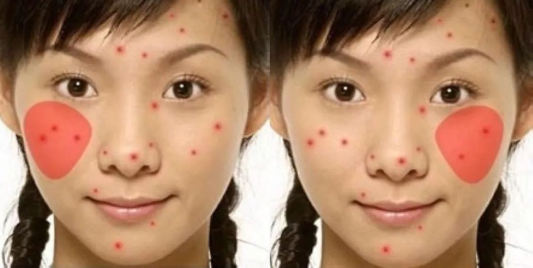 为什么明星不爆痘,熬夜真的会导致爆痘吗