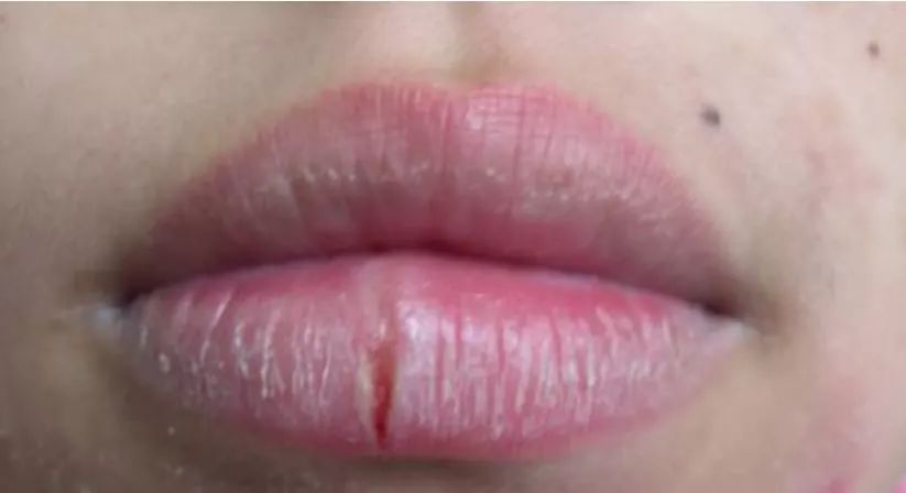 别让口腔难闻问题毁了你的颜值,别让你干裂的嘴影响你