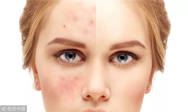 生活小妙招保护皮肤的方法,干燥敏感皮肤夏天怎么护理