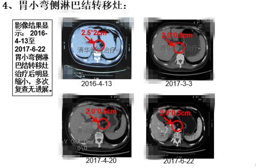 肺鳞癌能用nk细胞疗法吗,肺腺癌nkt治疗成功案例
