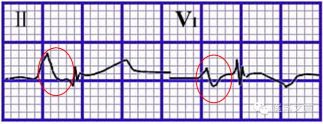 左心房肥大和右心房肥大心电图,心电图左室肥大右室肥大