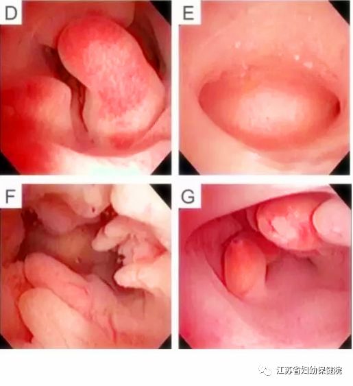 子宫内膜息肉的医学解释,子宫息肉的有关科普
