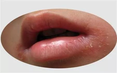 别让口腔难闻问题毁了你的颜值,别让你干裂的嘴影响你