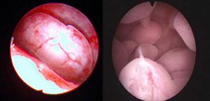 子宫内膜息肉手术影响经期吗,子宫内膜息肉宫腔镜手术时间