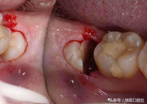 拔牙之后可以不拆线吗,拔牙后不拆线有影响吗