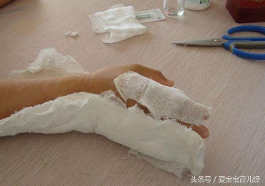 妈妈一时疏忽大意，导致4岁男童3根手指“骨折”！