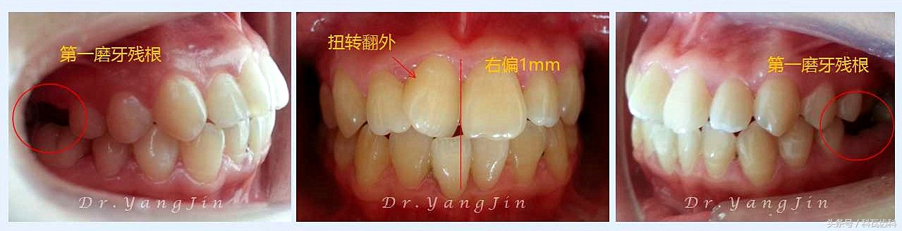 青少年适合种植牙还是假牙,缺牙活动假牙修复