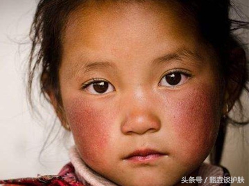 怎么修复红血丝敏感肌肤,修复敏感红血丝的方法