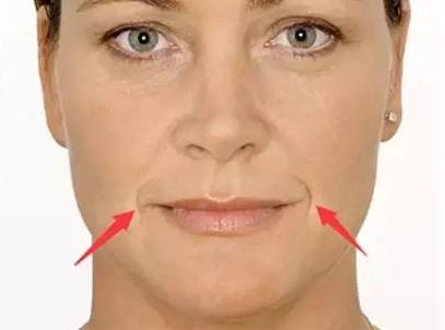 嘴角纹有什么办法去除,嘴角纹怎么消除吃什么食物好