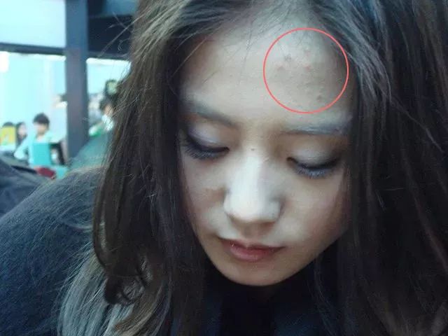 郑爽屏幕前貌美如花，幕后满脸痘花，明星都被坑的痘痘该怎么治？