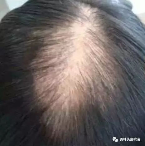 脱发案例丨菩叶毛囊赋活30天，生发效果立竿见影！
