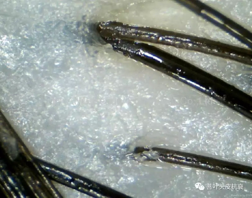 脱发案例丨菩叶毛囊赋活30天，生发效果立竿见影！