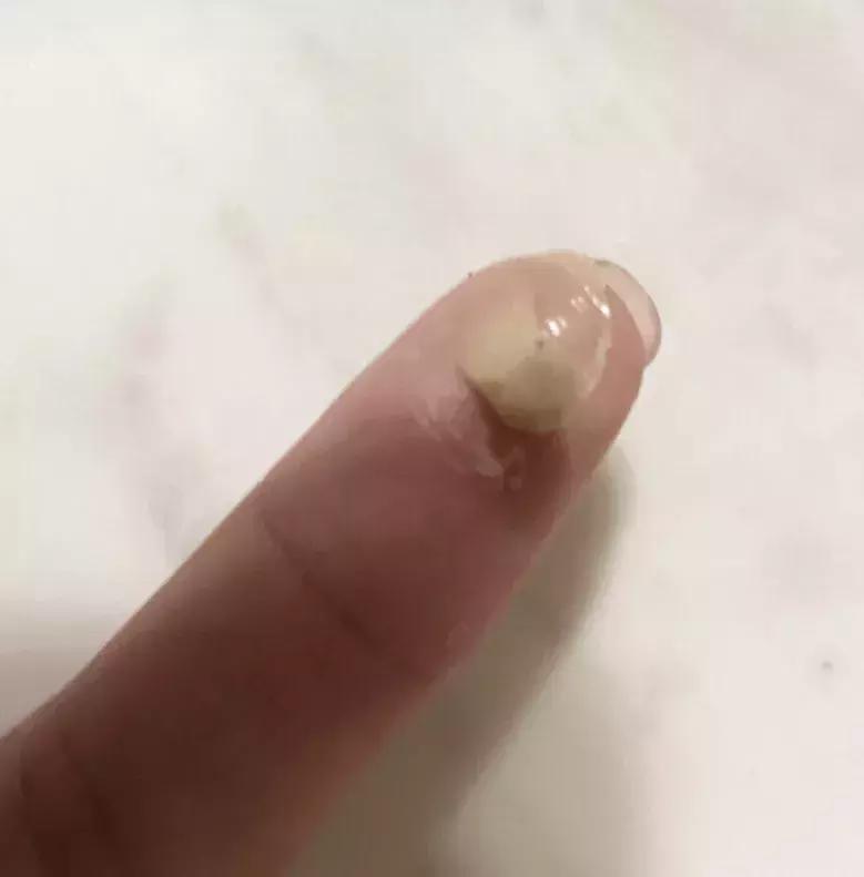 感觉脸上有痘痘但是不明显怎么办,脸上痘痘又爆发