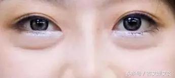 去眼袋的艾灸方法,孩子眼圈黑眼袋大怎么艾灸