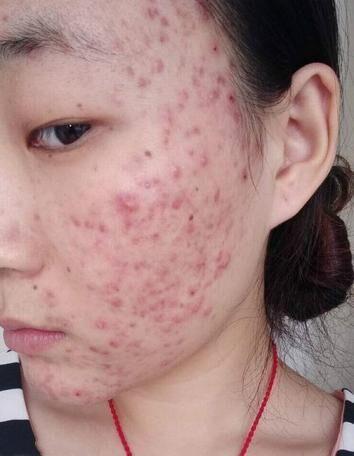 医生推荐祛痘印最有效的方法,去痘印省钱小技巧