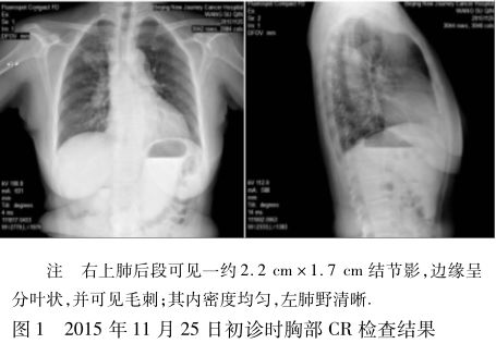 直肠癌和原发性肺腺癌,直肠癌合并卵巢癌