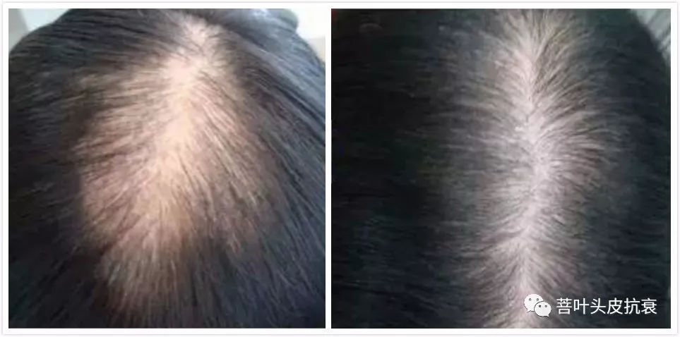 脱发案例丨菩叶毛囊赋活30天，生发效果立竿见影！