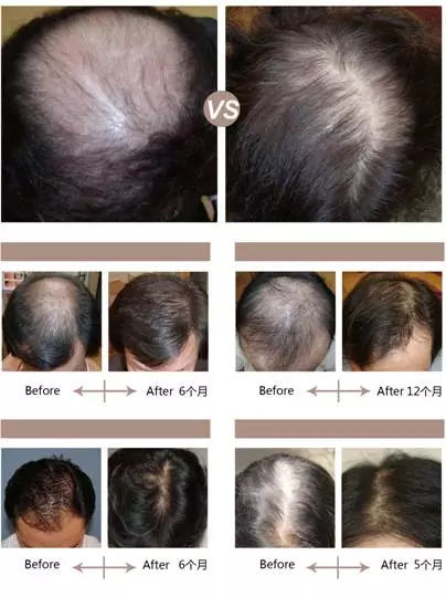 脱发案例丨菩叶毛囊赋活30天，生发效果立竿见影！