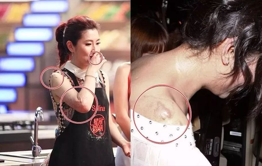 去疤小妙招不弄药水,祛疤小方法