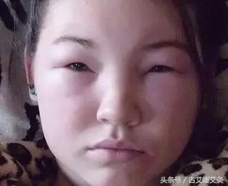 去眼袋的艾灸方法,孩子眼圈黑眼袋大怎么艾灸