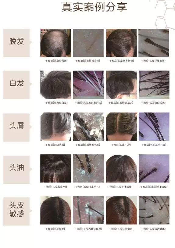 脱发案例丨菩叶毛囊赋活30天，生发效果立竿见影！