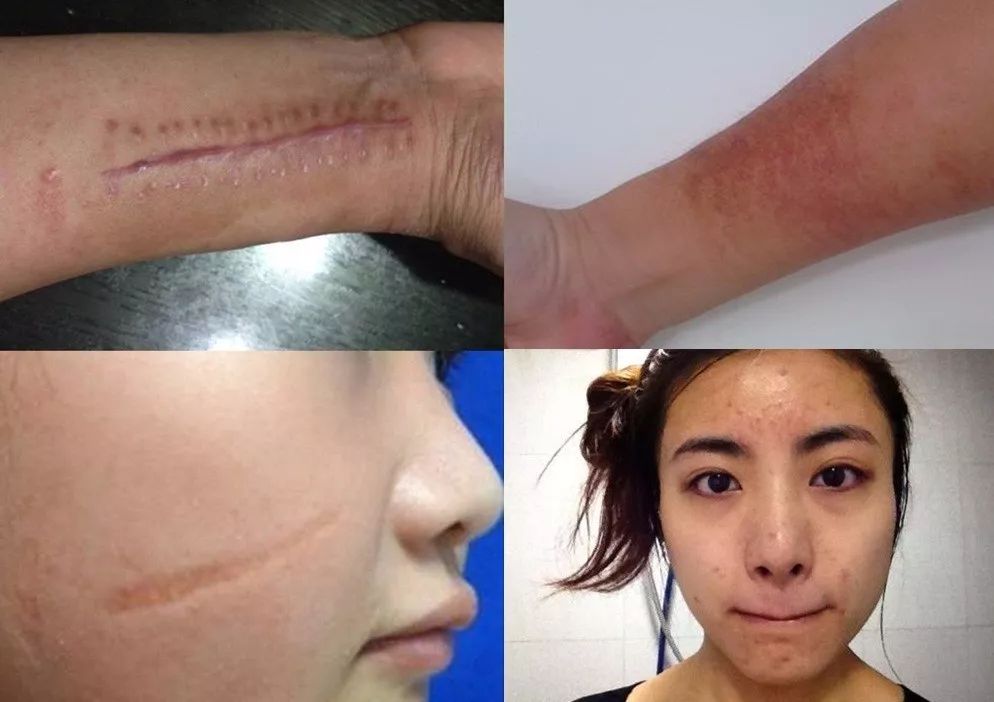 去疤小妙招不弄药水,祛疤小方法