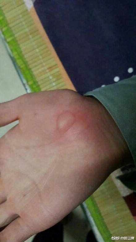 被老师卖到工厂实习手受伤了,学生被卖进厂