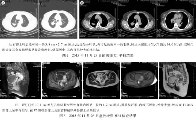 直肠癌和原发性肺腺癌,直肠癌合并卵巢癌