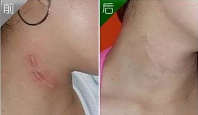 去疤小妙招不弄药水,祛疤小方法