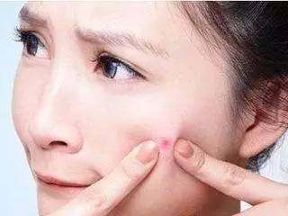 小宇老师告诉你：不痛不痒小疙瘩，闭口粉刺究竟是什么鬼？