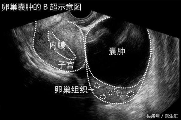 肚子绞痛并且鼓包怎么回事,卵巢囊肿腹痛说明破裂了吗