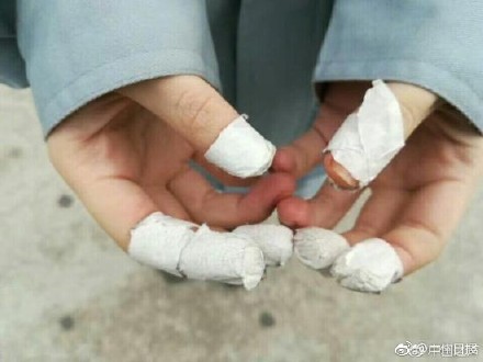 被老师卖到工厂实习手受伤了,学生被卖进厂