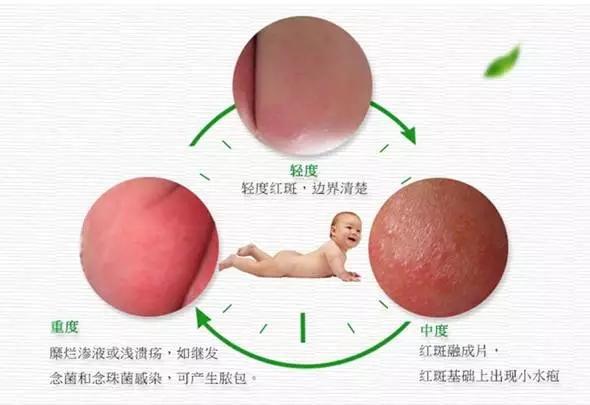 痱子与湿疹别用错方法,痱子和湿疹应该如何区分