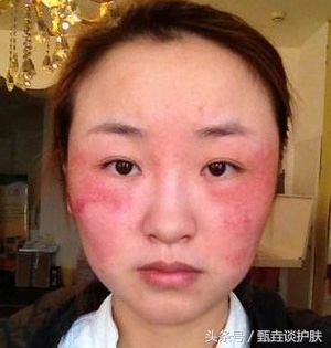 皮肤敏感红血丝怎么修复,红血丝严重敏感肌肤适合什么治疗