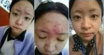 去疤小妙招不弄药水,祛疤小方法