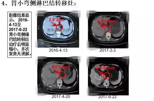 肺腺癌晚期nkt细胞免疫治疗价格,肺癌晚期nk细胞疗法